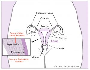 uterine cancer