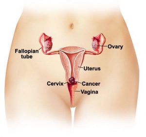 CERVICAL CANCER
