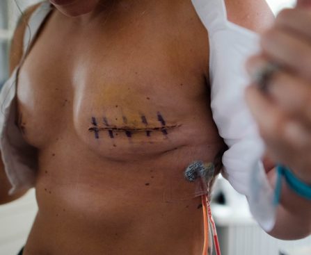 The Mole-Breast Cancer Connection