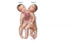 TOGETHER FOREVER: A JOURNEY OF CONJOINED TWINS