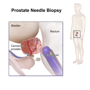 PROSTATE CANCER