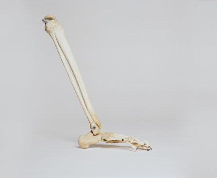 BROKEN LEG:SYMPTOMS AND COMPLICATION