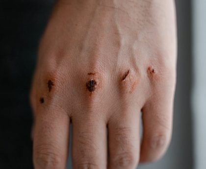 CELLULITIS UNVEILED: CAUSES SYMPTOMS TREATMENT AND PREVENTION