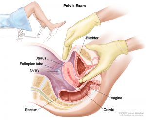 POLYCYSTIC OVARY SYNDROME